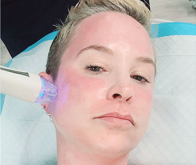 VYBE RF procedure